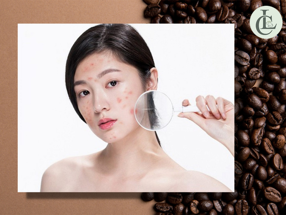 Uống cà phê có nổi mụn không?