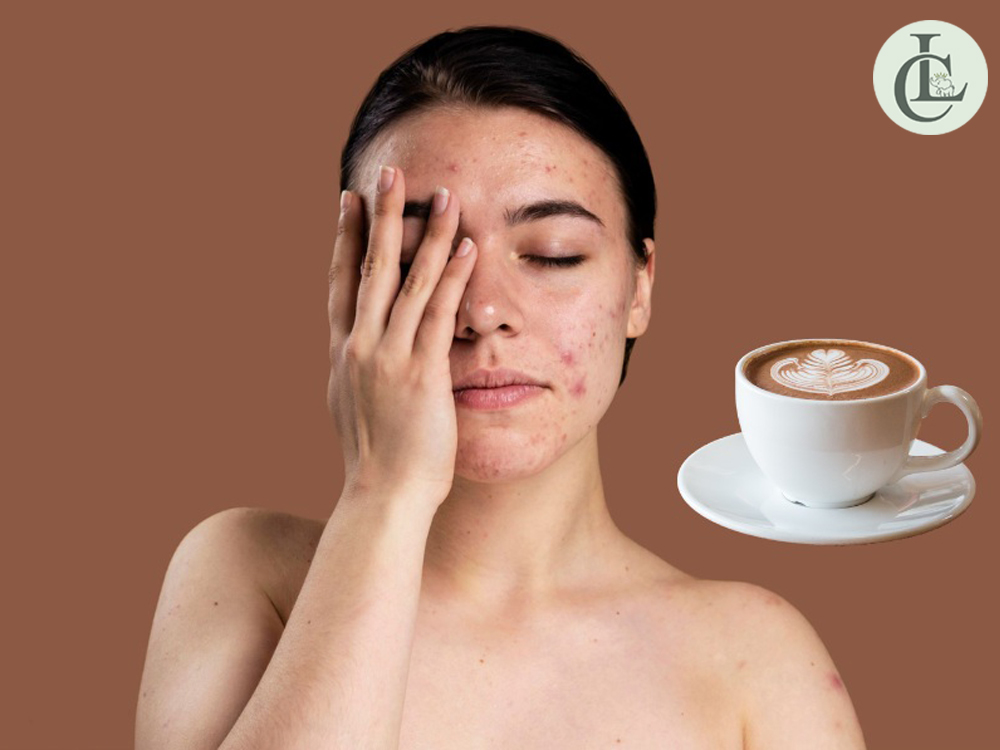 Uống cà phê có nổi mụn không?